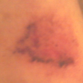 Busted Knee Busted Knee